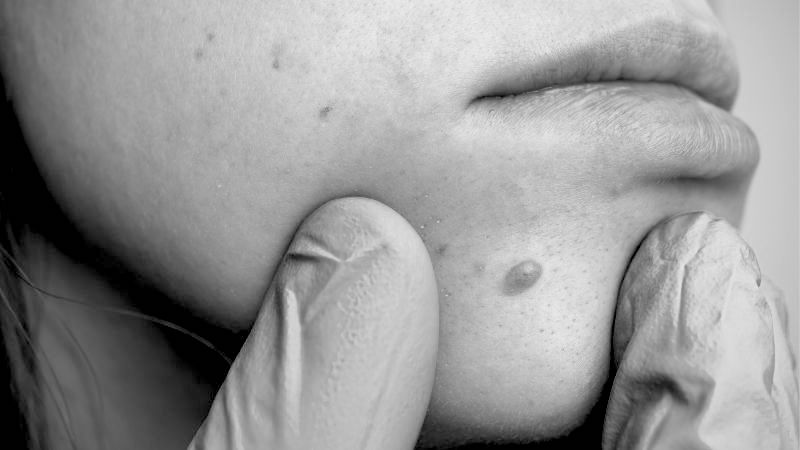 Cost of Skin Tags Removal Treatment in Newbury