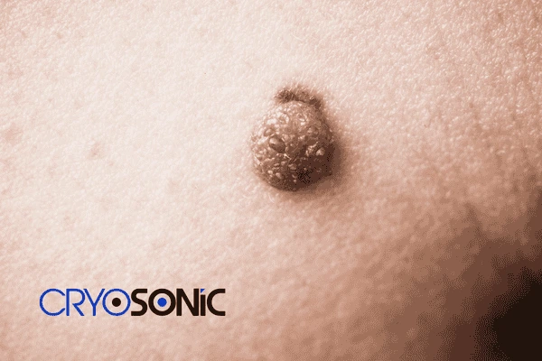Looking for non surgical Dermatofibroma removal Newbury? Contact us today Newbury