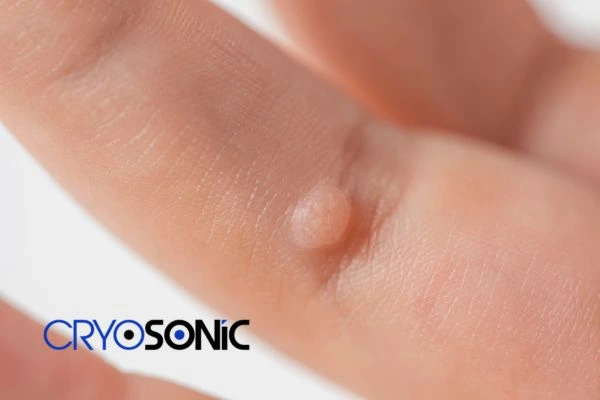 Contact Cryosonic today to learn more about us Newbury now! Newbury