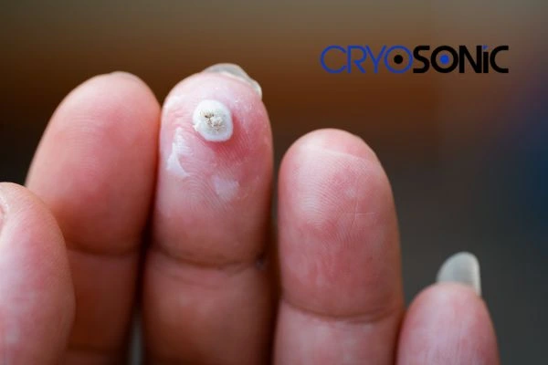Learn more about us Newbury at Cryosonic. Book in today! Newbury