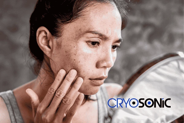 Book your sun damaged skin treatment online today in Newbury
