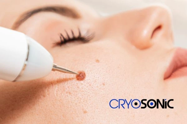 why choose us at Cryosonic for blemish removal? Find out more now Newbury