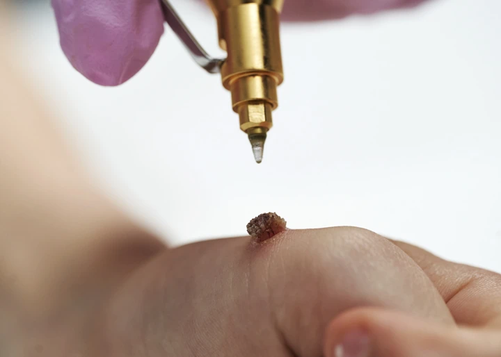 Cryopen For Children Bristol Newbury