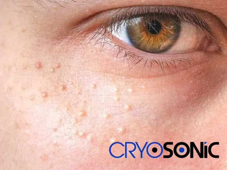 Cryosonic&rsquo;s CryoPen Approach to Milia Removal Newbury Newbury