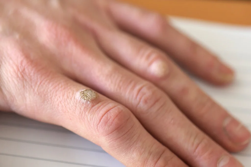 What to Expect After Warts Removal in Newbury Newbury