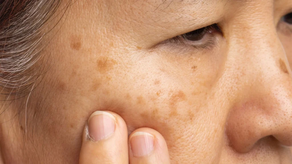 Seborrhoeic Keratosis Healing Process and Aftercare Advice Newbury