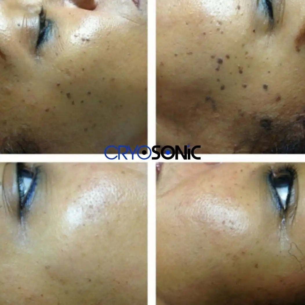 Why Skin Shows Pigmentation After Treatment Newbury