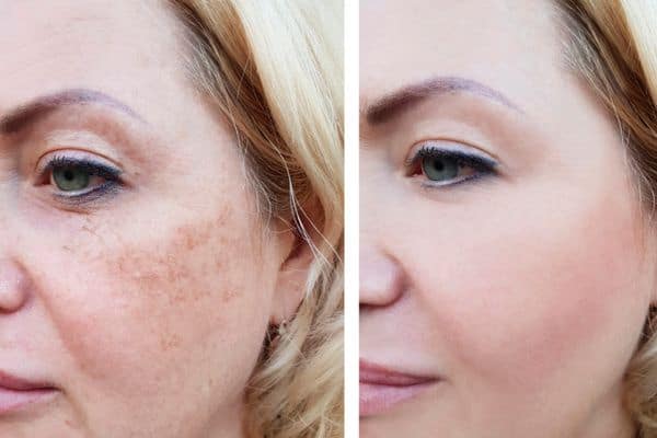 Before and after Ephelides Treatment Newbury