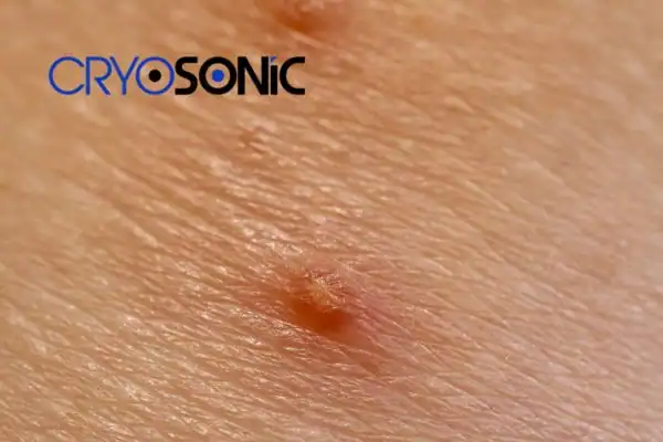 Molluscum Contagiosum Treatment Newbury Newbury