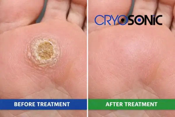 Before and after results of Porokeratosis Treatment Newbury Newbury