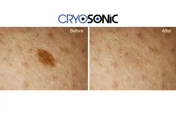 Before and after age spot removal Newbury Newbury