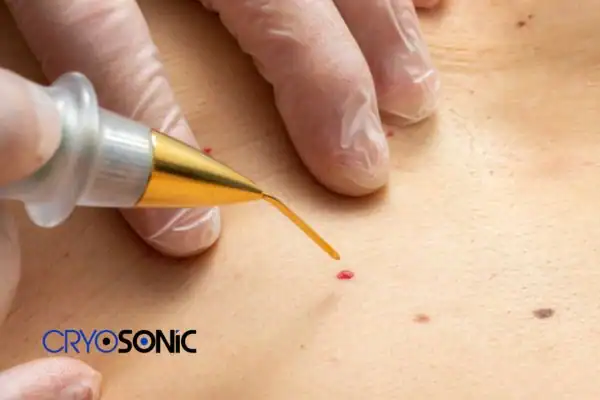 Image of cherry angioma removal Newbury Newbury