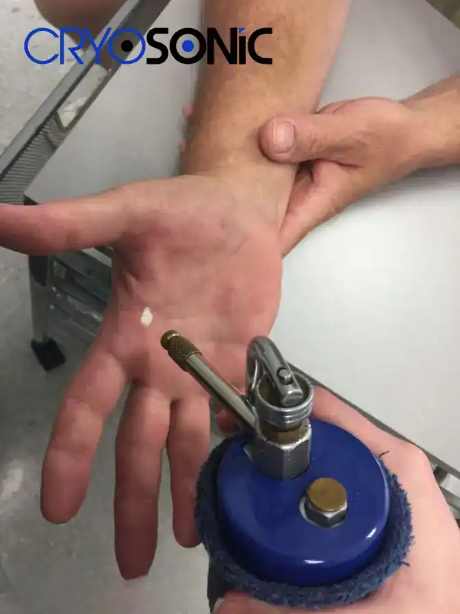 Temperature Differences: OTC vs Medical-Grade Cryotherapy Newbury
